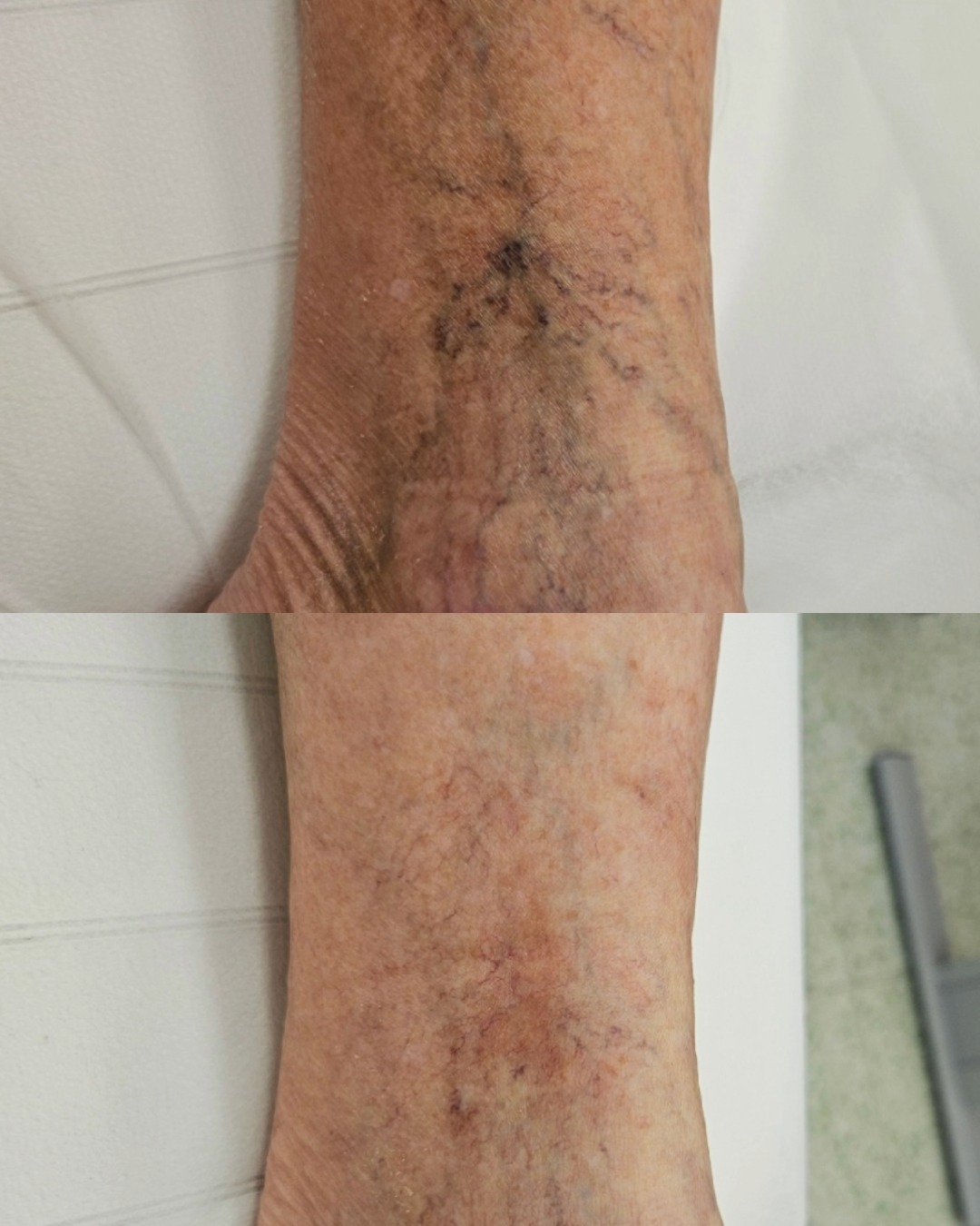 Removal of veins on the inner ankle