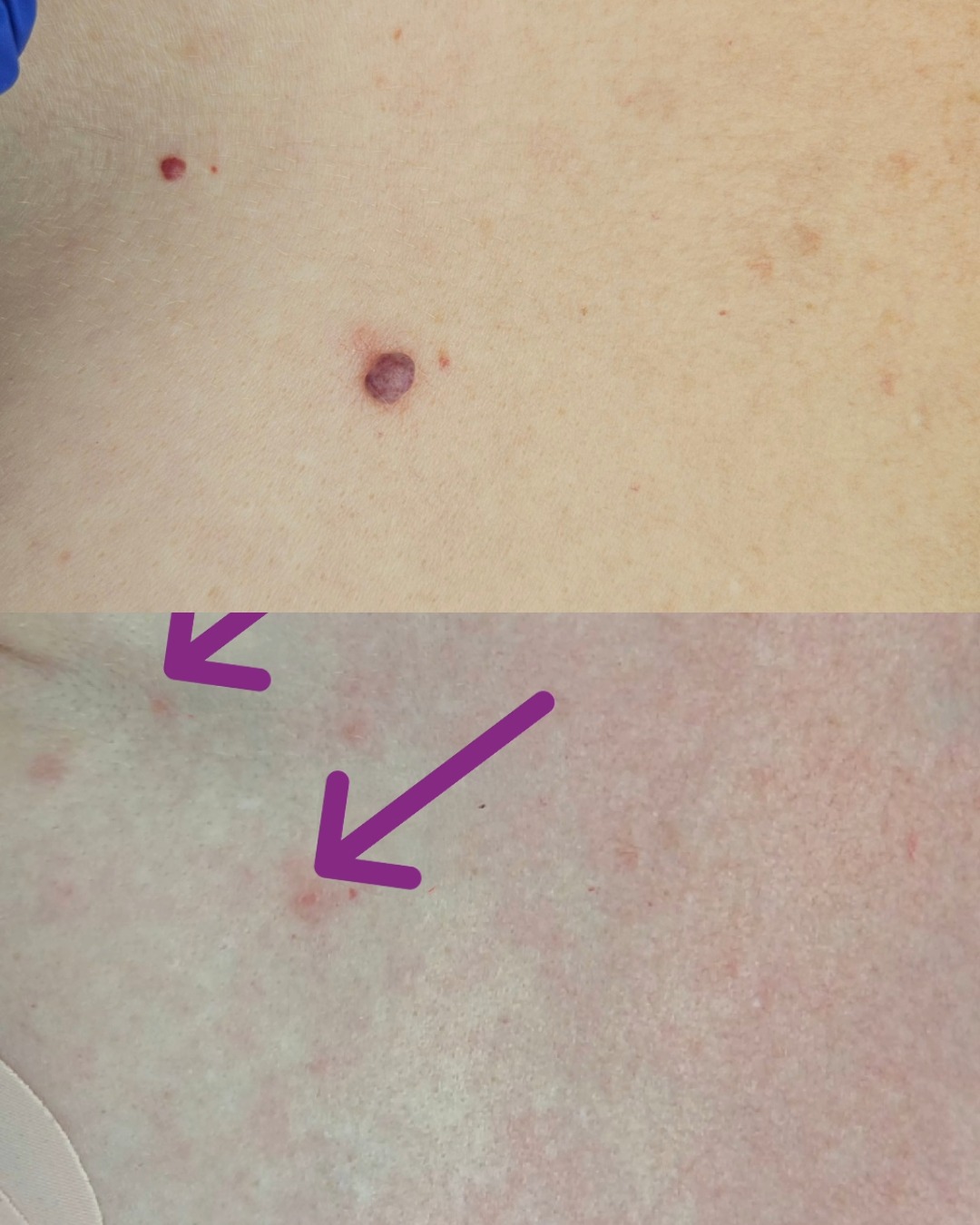 Removal of hemangioma in the décolleté area