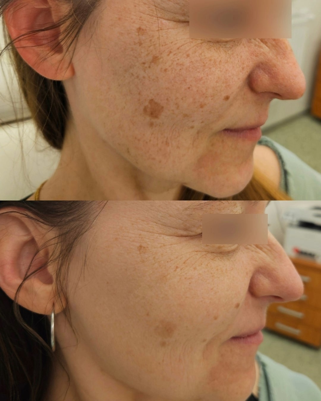 Reduction of pigmentation on the face