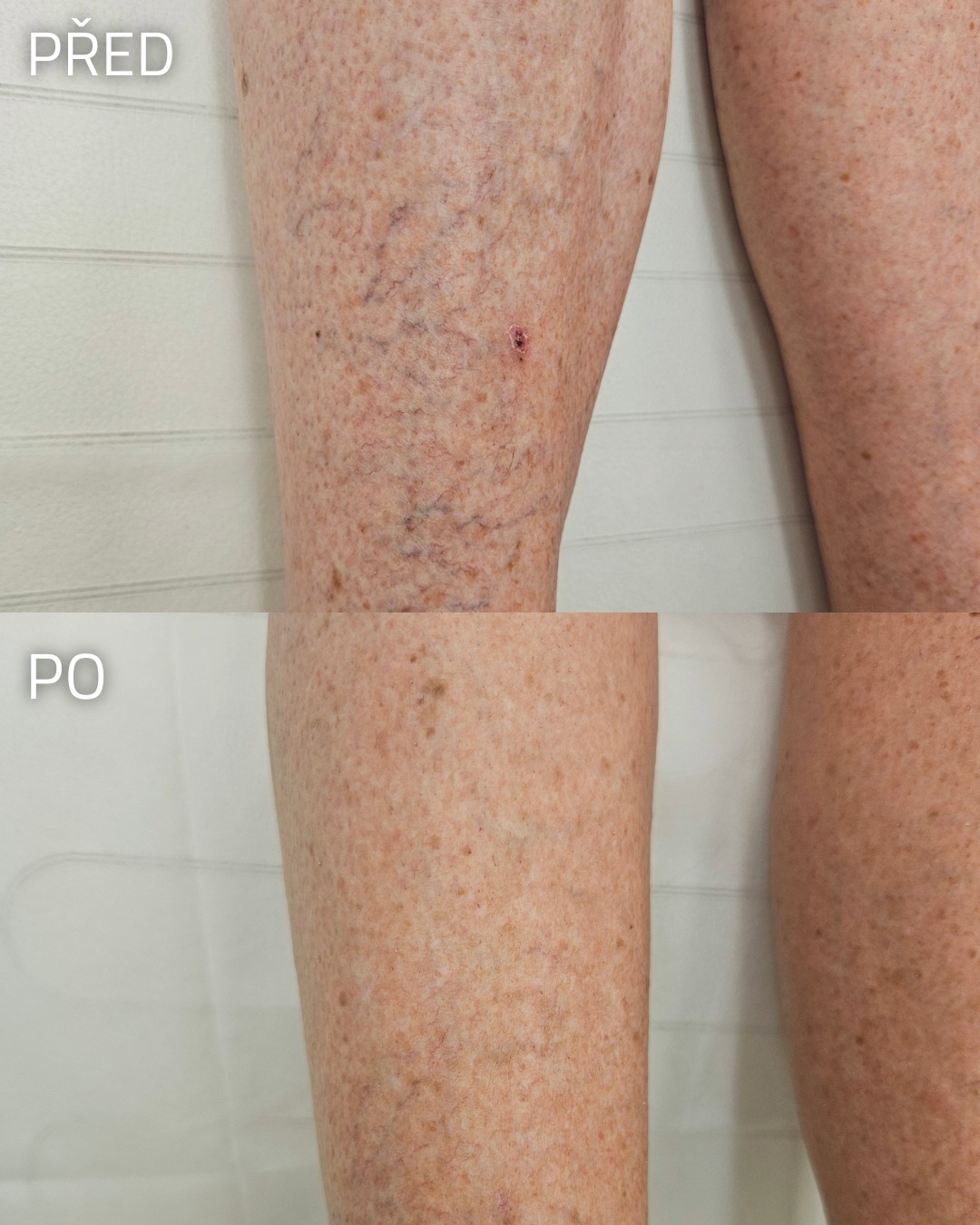 Odstranění žilek pomocí Vasculaze v oblasi bérce